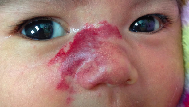 infantile hemangiomas