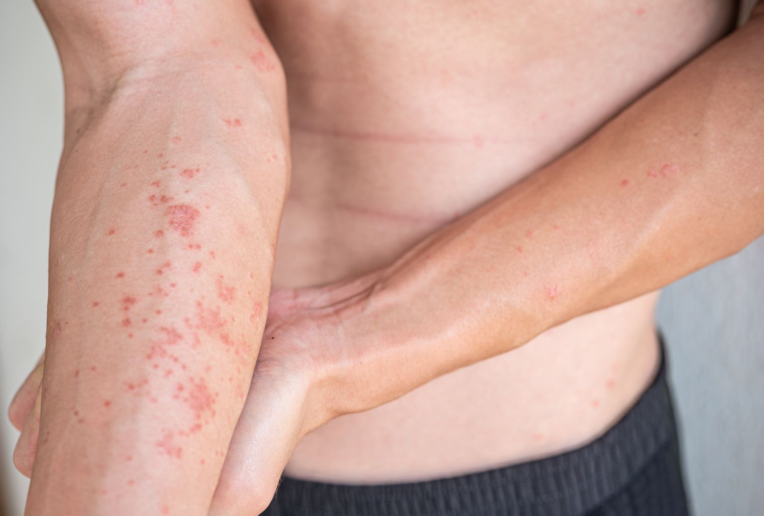 Atopic Dermatitis treatment