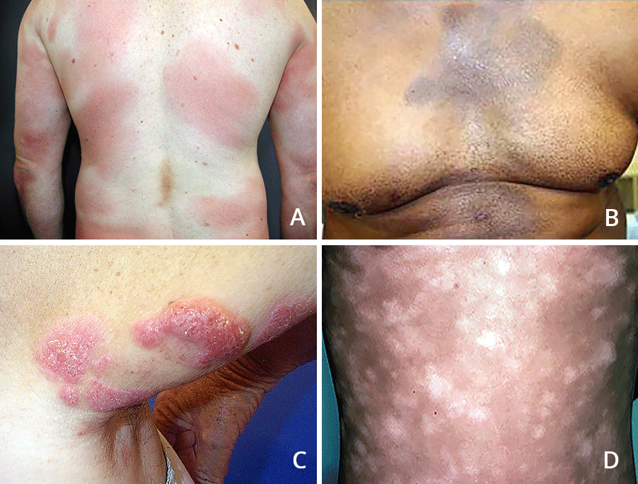 cutaneous t cell skin cancer